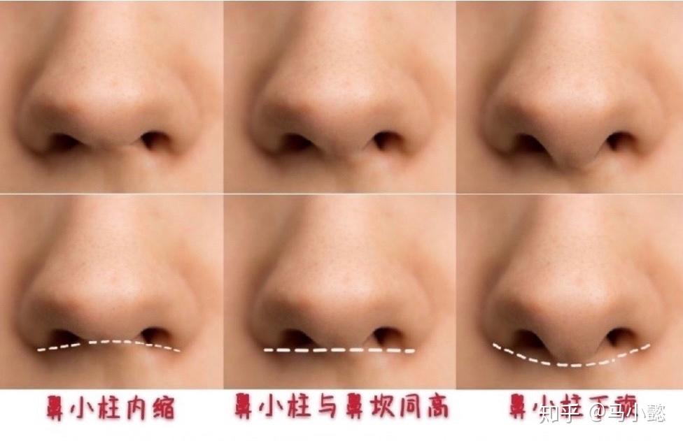 隆鼻审美如何塑造最适合自己的海鸥线不同鼻尖形态对人中长度面部成熟