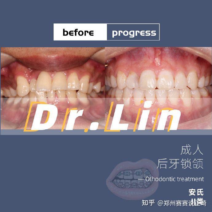 郑州牙齿矫正|成人后牙锁颌 - 知乎