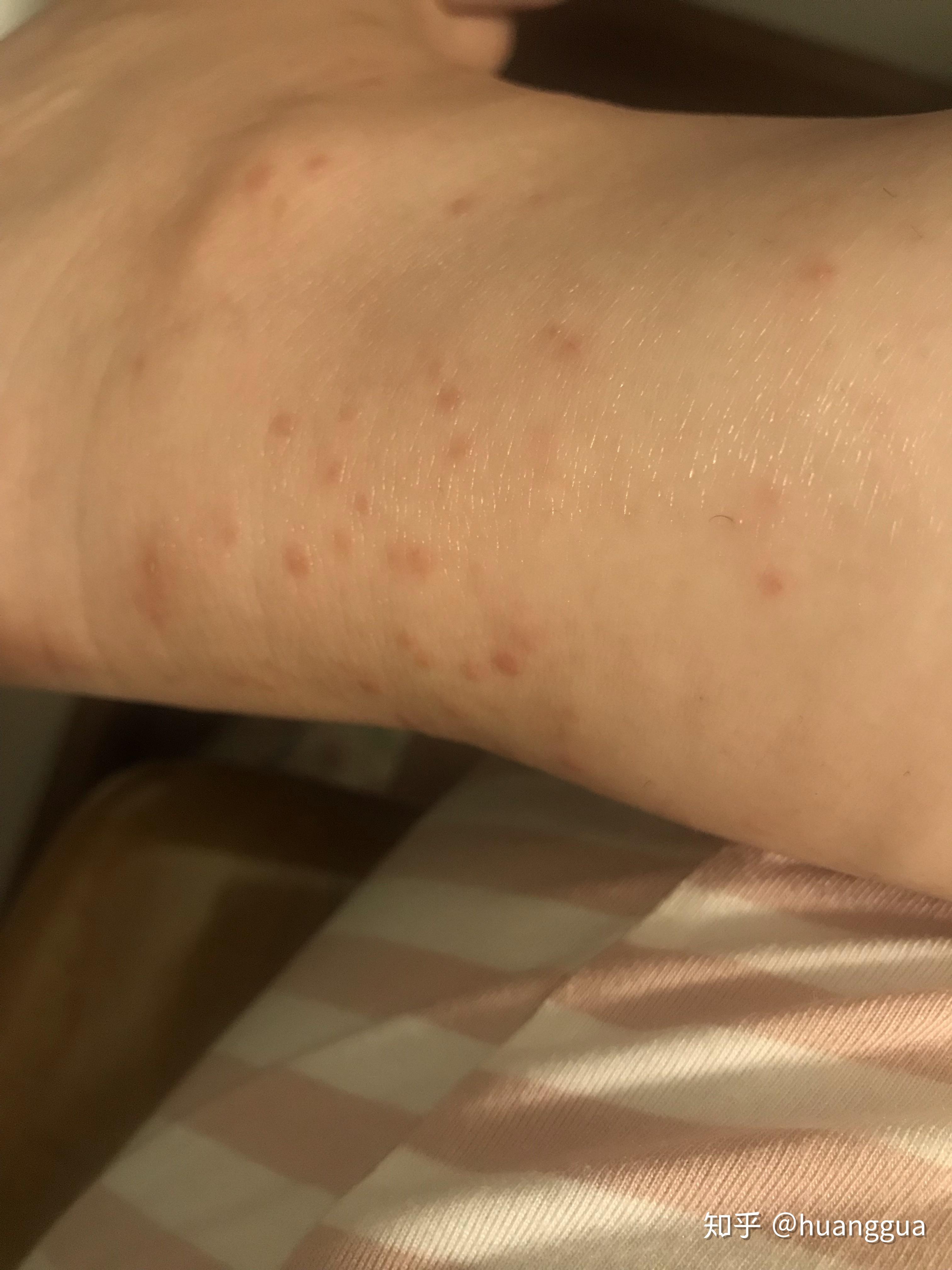 被蚊子咬的小红点图片
