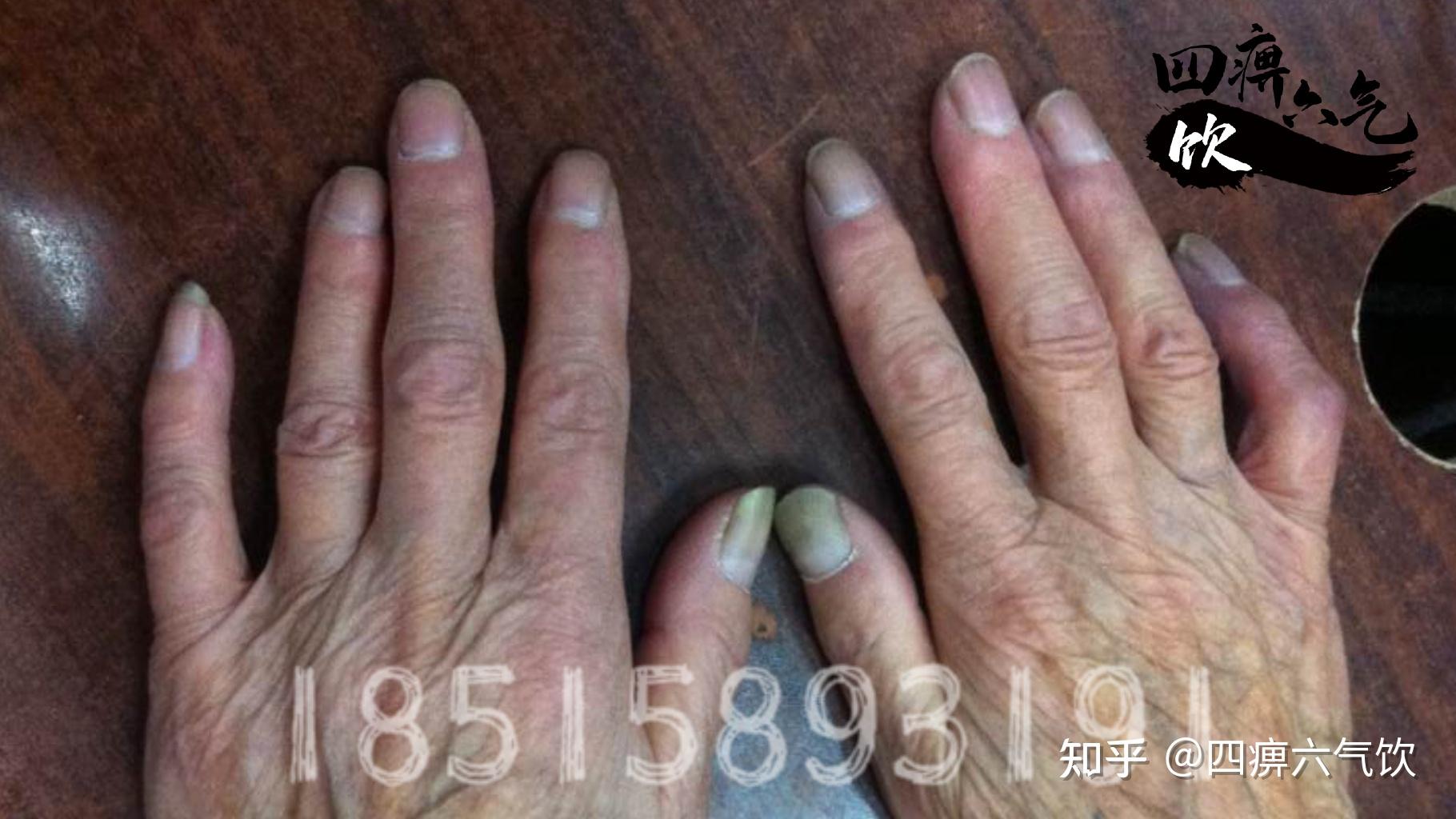 潍坊交通医院专家成功治愈雷诺氏症患者 张女士手部症状完全缓解 - 哔哩哔哩