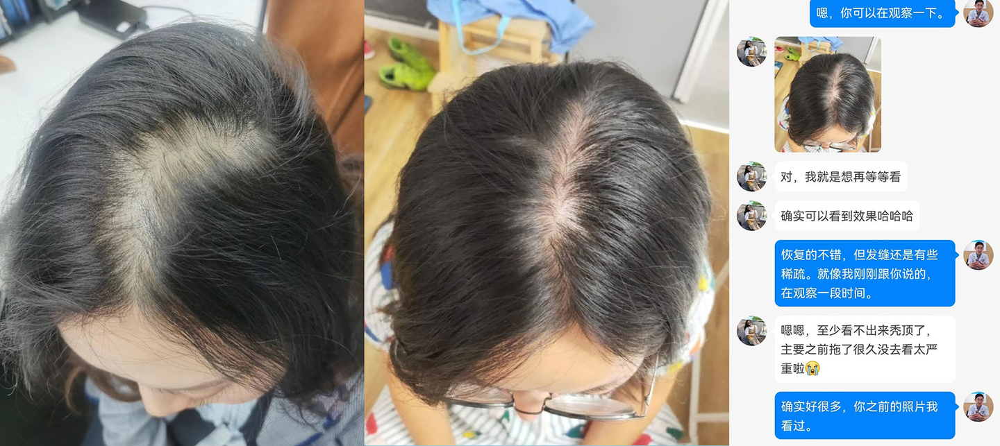 发缝稀疏治疗几个月,大家觉得效果怎么样? - 知乎