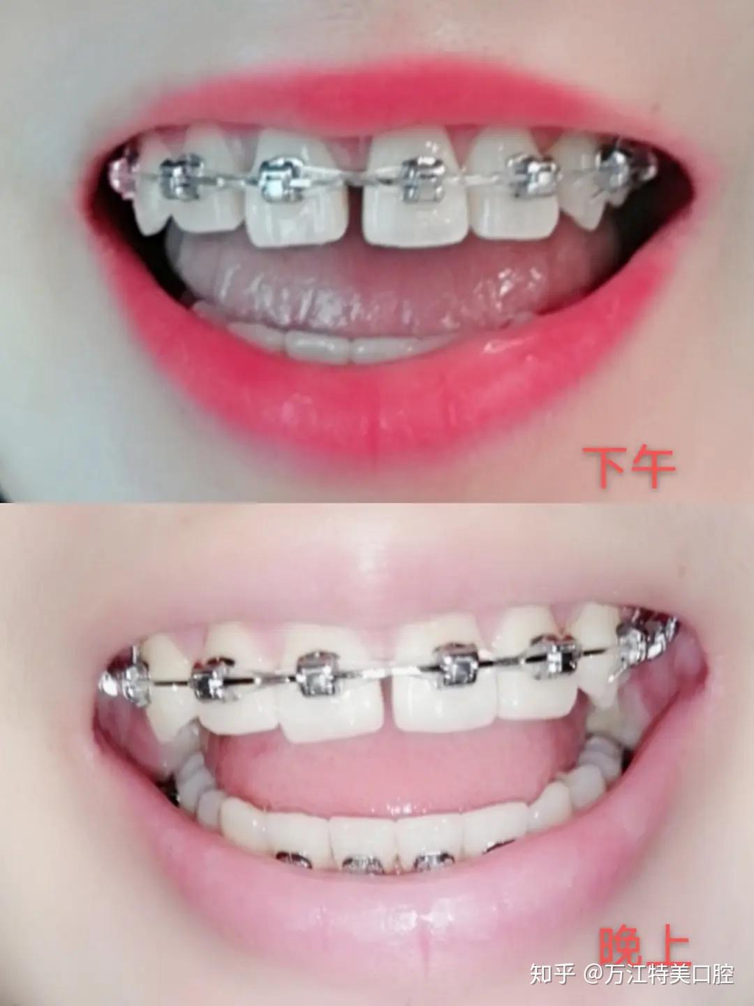 牙齿矫正虎牙逆袭
