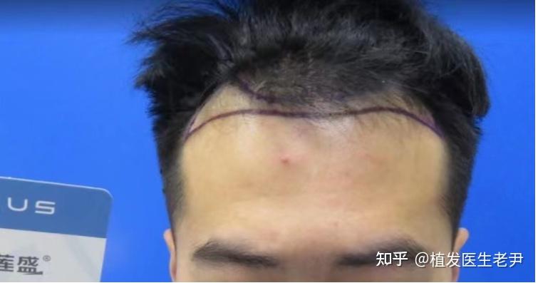 植发1000单位效果图