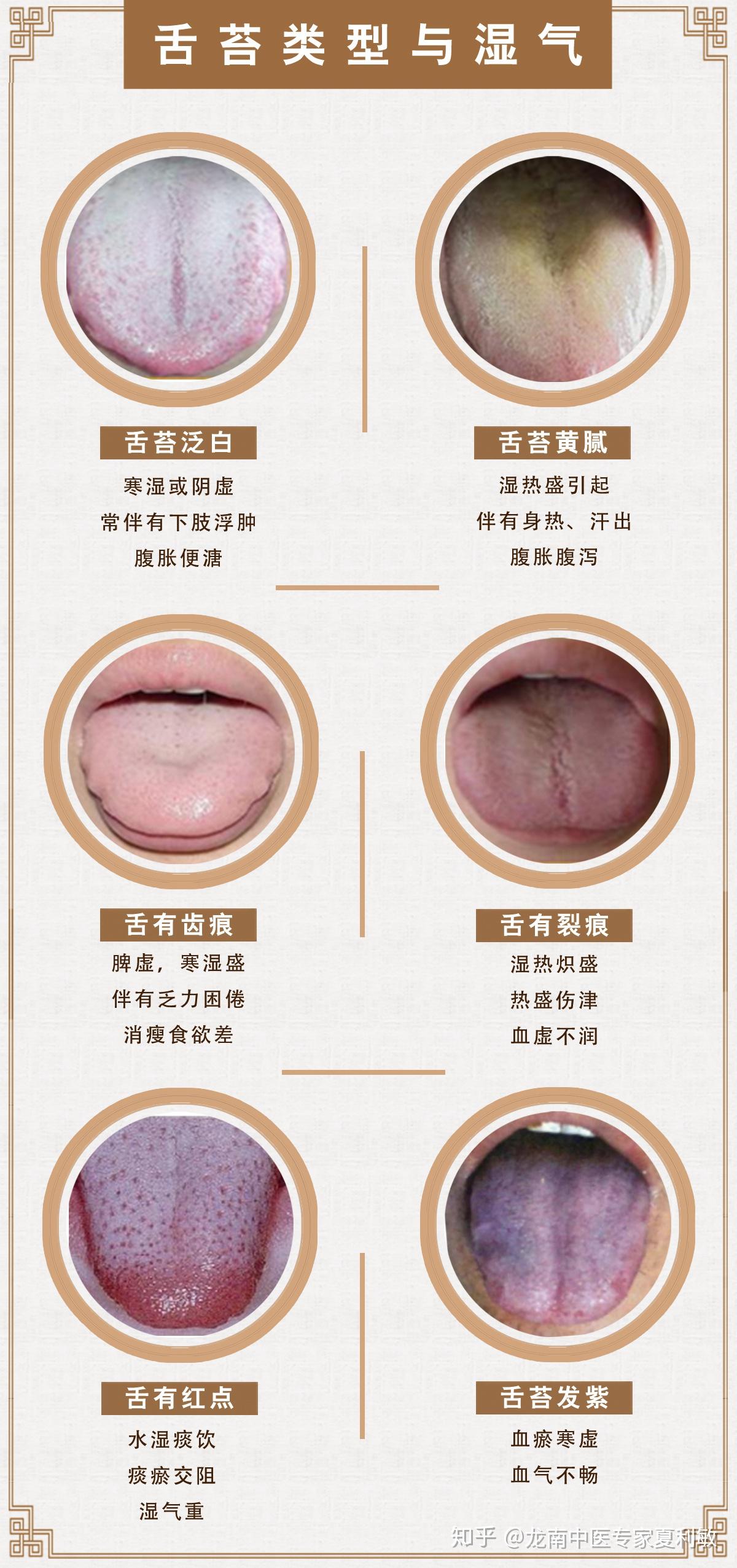 舌头上出现了齿痕,这是怎么回事? - 知乎