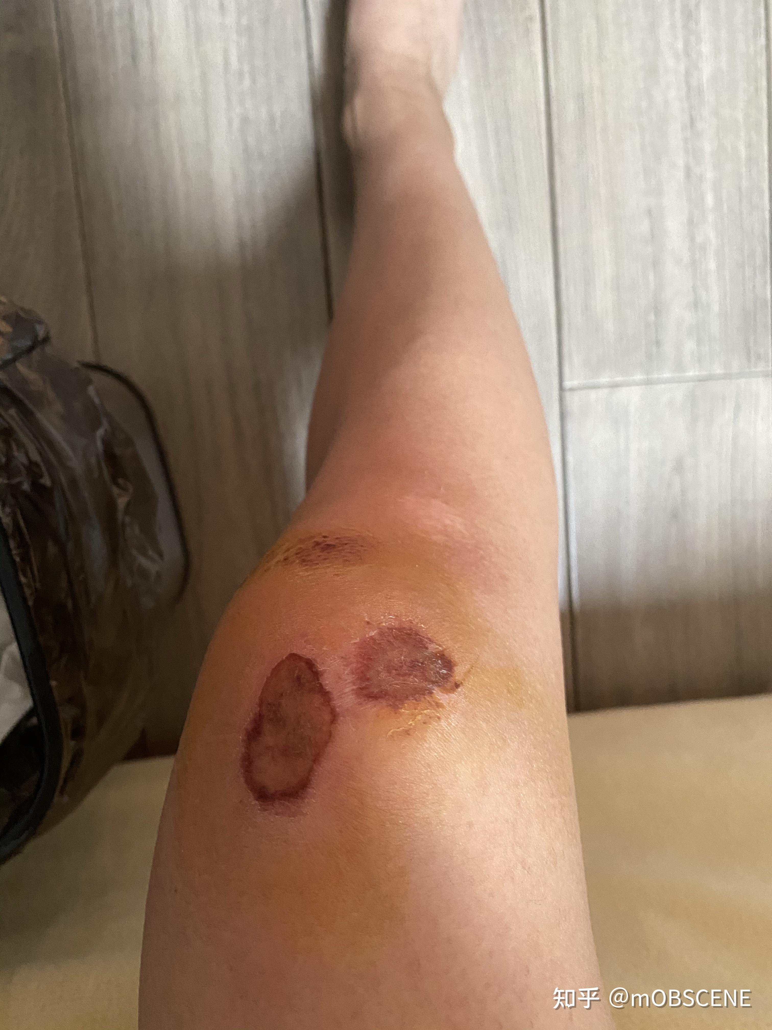 记录膝盖擦伤 - 知乎