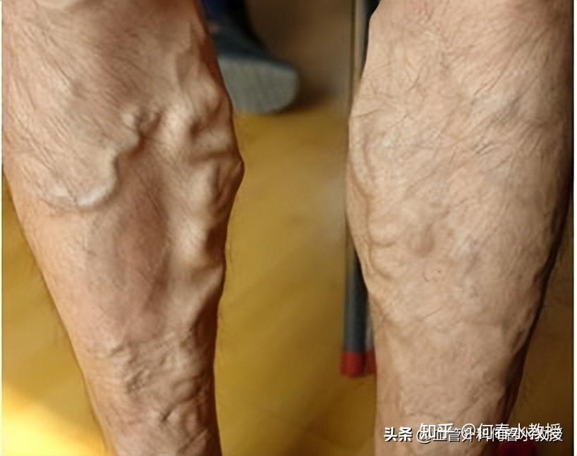 假如血管外科医生说真话,打针就能治疗静脉曲张,这是真的吗?