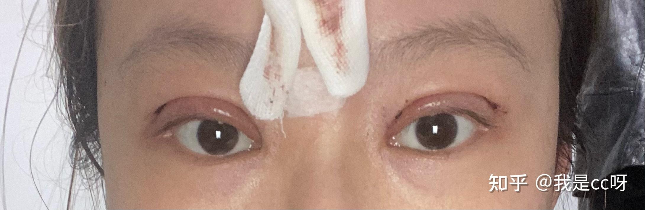 (做完双眼皮才知道后悔!!)双眼皮手术记录贴(全切 8mm) - 知乎