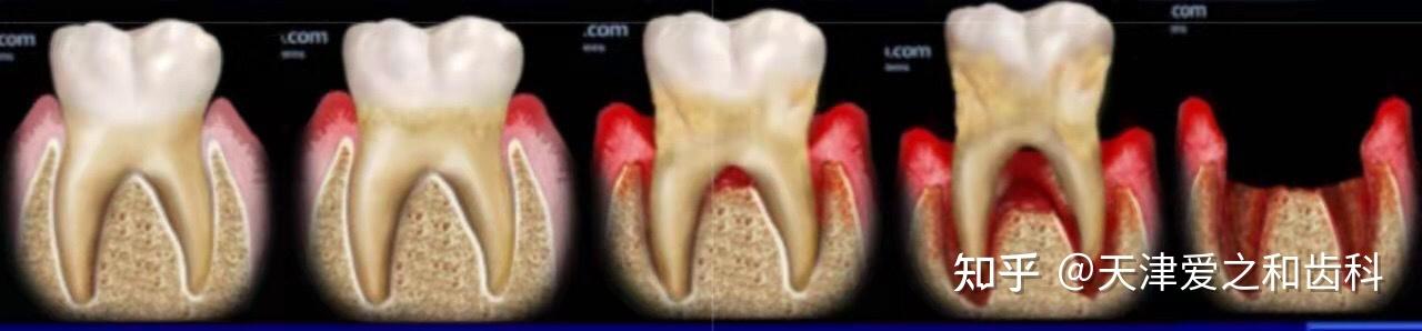 牙周炎之侵襲性牙周炎的恐怖之處
