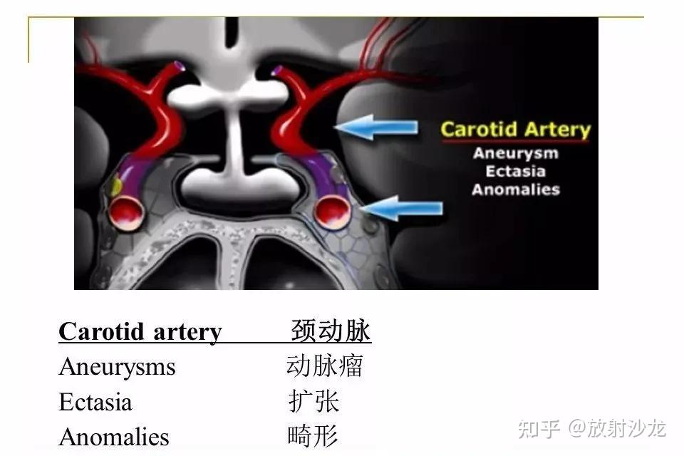 【收藏】蝶鞍及鞍旁区域解剖 - 知乎