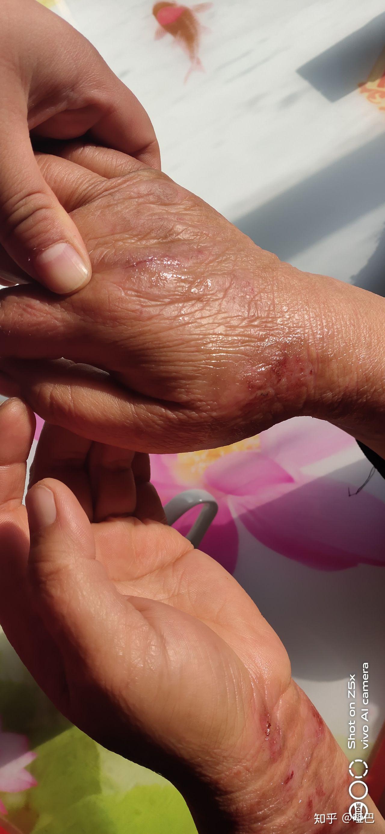 我妈的手腕挠烂了帮忙看看有治吗?(图片)