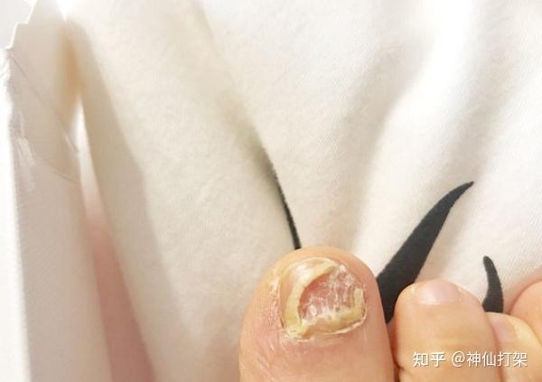 灰指甲怎样快速治疗 v2-8b648b007a93241fb15b021257483b86_r.jpg