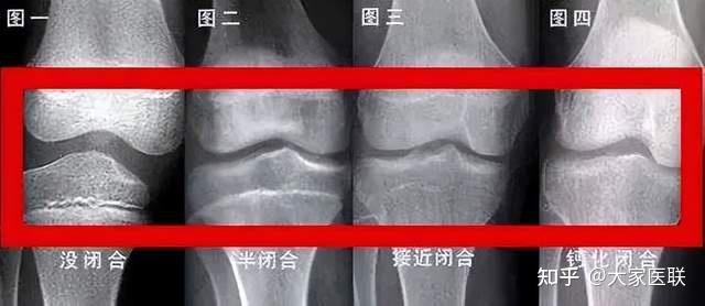 孩子骨骺线闭合前的信号，赶在这个时间点干预，或许能多长十厘米 - 知乎