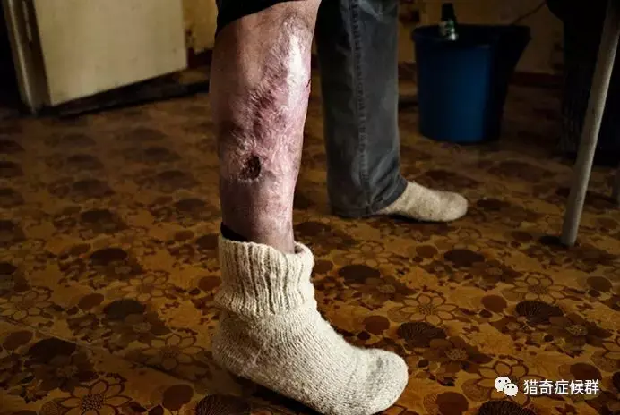 黑视界致命毒品鳄鱼不惜骨肉分离全身溃烂的瘾君子们何时会去地狱