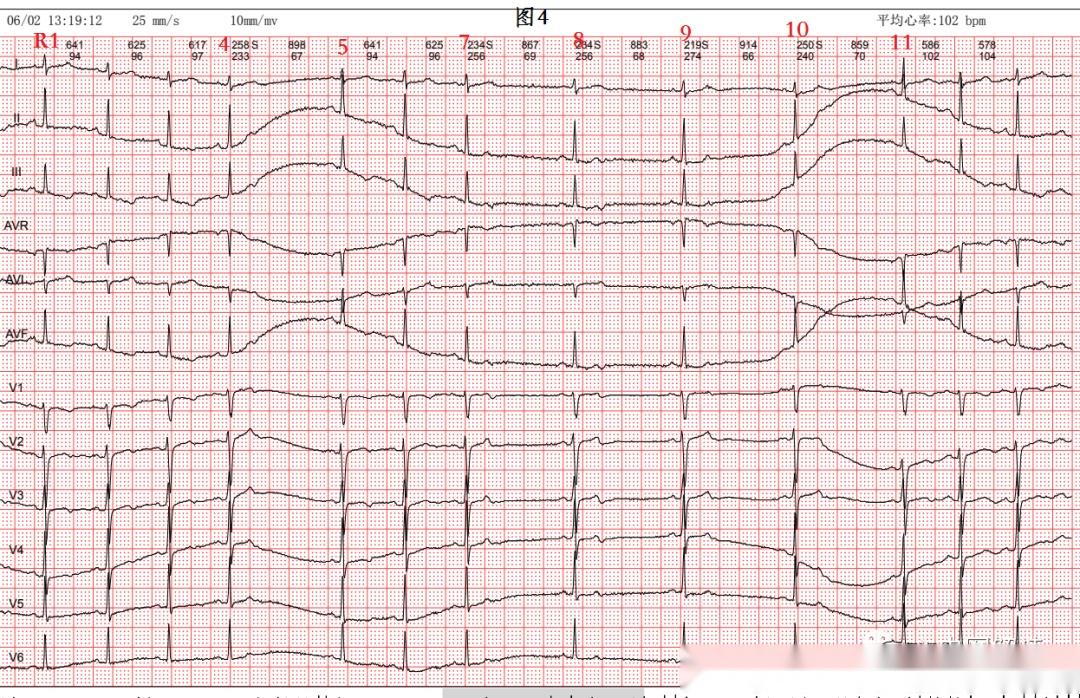 房早未下传心电图图片图片