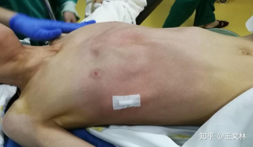 今天的手术:鸡胸的超微创手术与改良nuss手术 - 知乎