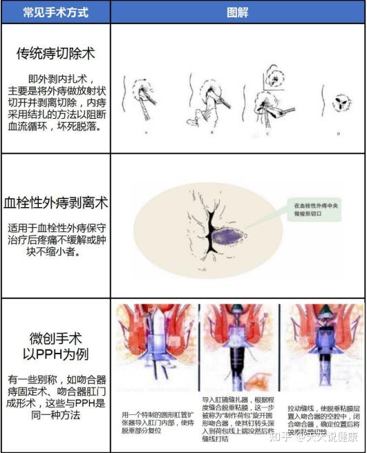 痔疮有微创手术么?