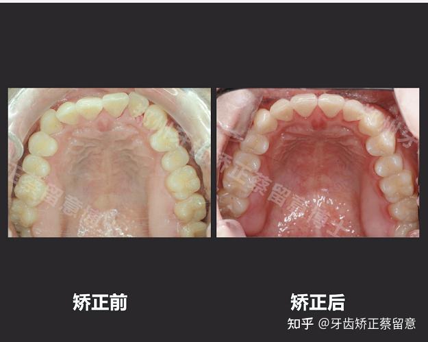 鄭州牙齒矯正高難度舌側矯正案例骨性地包天單純正畸改善大不大