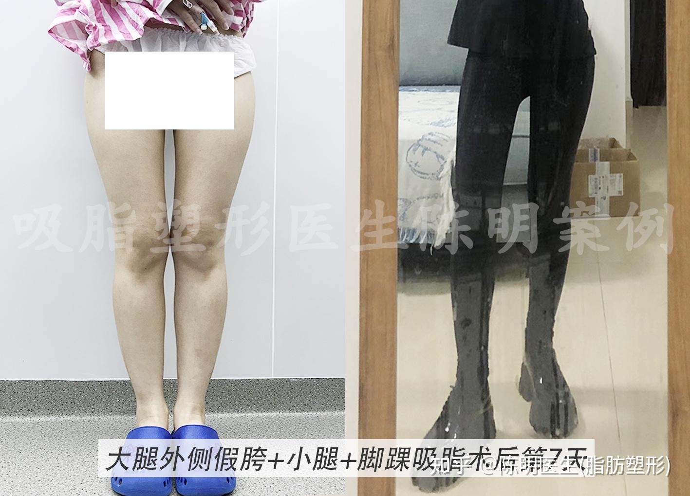 韩国一路美整形外科吸脂瘦大腿怎么样_恢复过程_效果如何_三三喵了个喵整形日记9.22_新氧美容整形