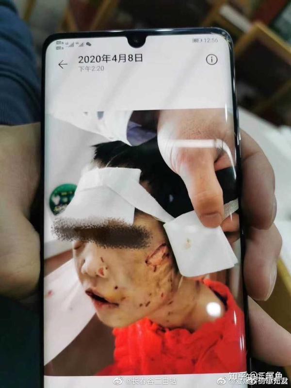 黑龙江佳木斯虐童案————再一次,年幼的孩子惨遭魔爪 - 知乎