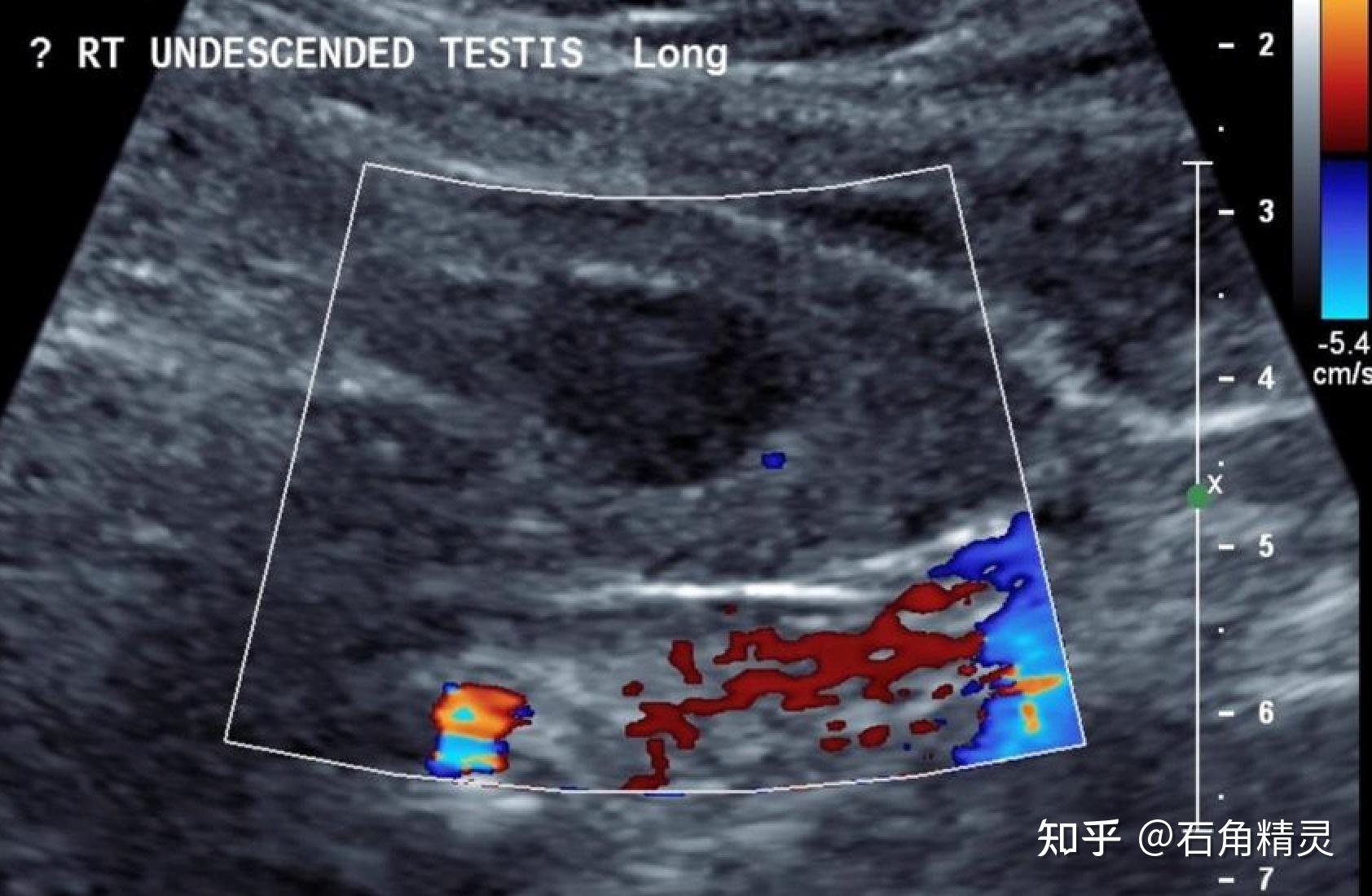 八、隐睾-小儿腹部CT诊断图鉴-医学