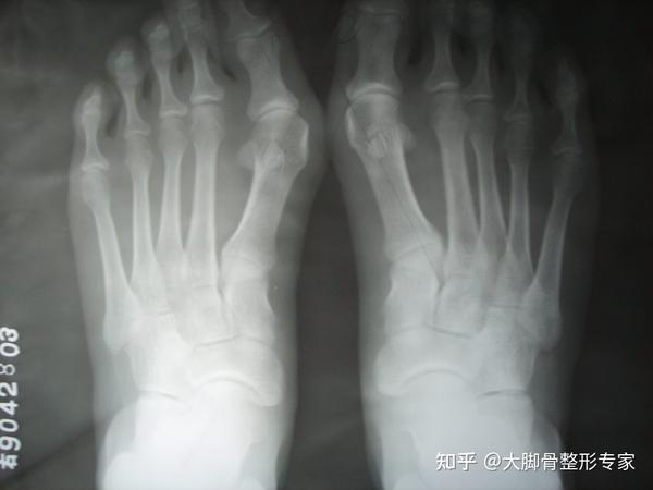 轻度拇外翻需要做手术吗？轻度拇外翻的处理办法 - 知乎