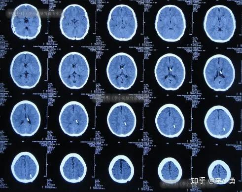 发作,李小勇脑脊液专业四脑室分流术六年后虽改善但仍需甘露醇降颅