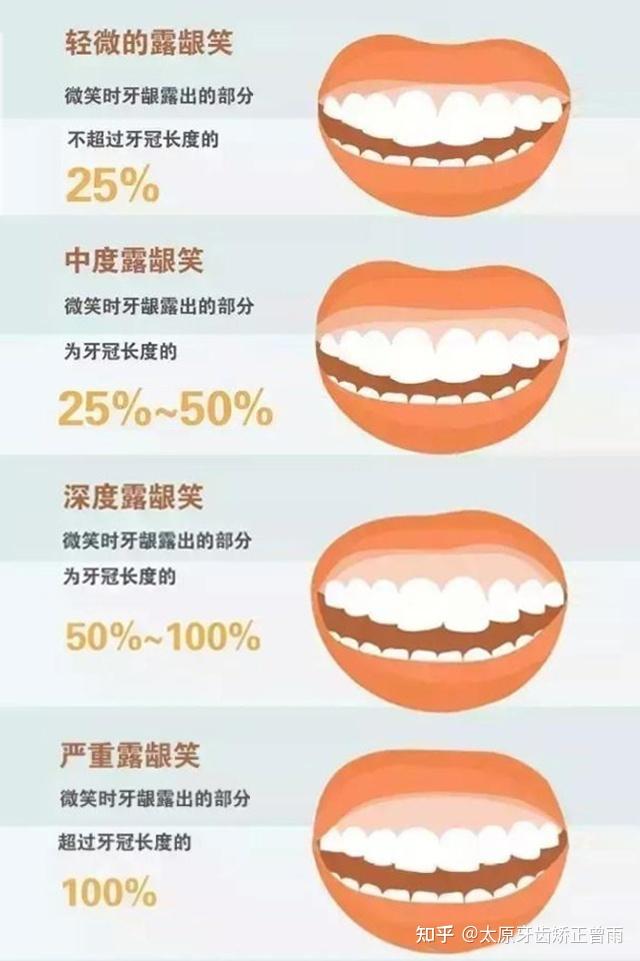 有一种毁容,让女孩都害怕的露龈笑 - 知乎