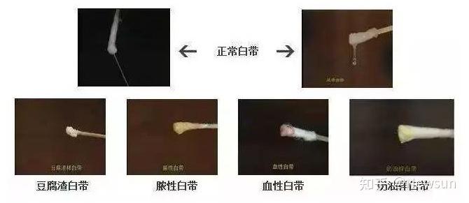 五,淋病等.女性朋友平时一定要注意妇科查体,随时关注白带情况.