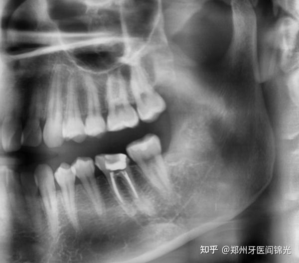 牙齿慢性根尖周炎的特殊形式——根尖周致密性骨炎 - 知乎