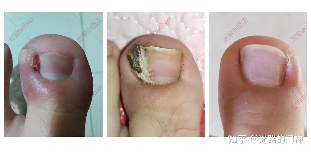 甲沟炎该如何治疗