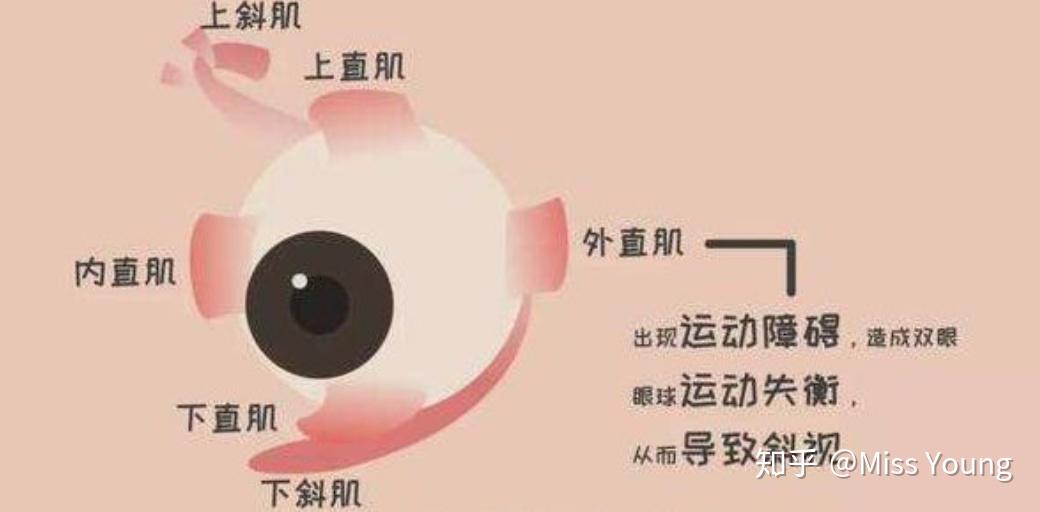 而斜视是一种眼外肌疾病,发病的主要原因就是负责控制眼球运动的肌肉