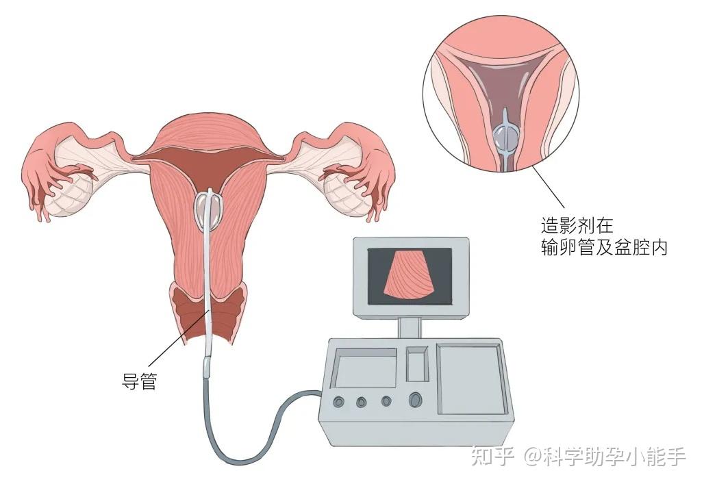 输卵管通液术过程步骤图片