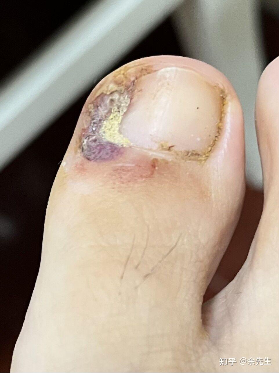 如果甲沟炎已经开始化脓了,自己应该怎么处理