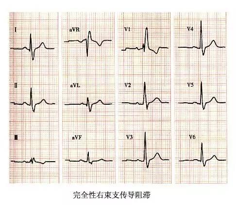 常见的心脏传导阻滞心电图 全在这里了 看到就是赚到 知乎