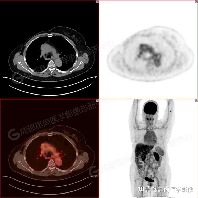 乳腺癌术后肝多发转移一例【PET/CT-MR多模态显像】 - 知乎