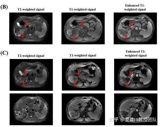 臨床試驗招募丨cart治療肝癌後生存期超8年腸癌胰腺癌