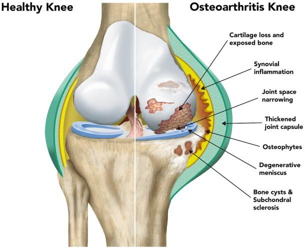 骨关节炎与免疫炎症