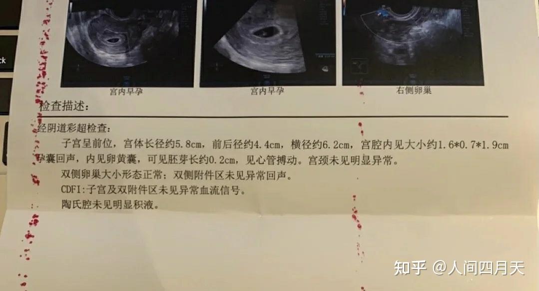 意外怀孕无痛,人工流产 成都人流手术 - 知乎