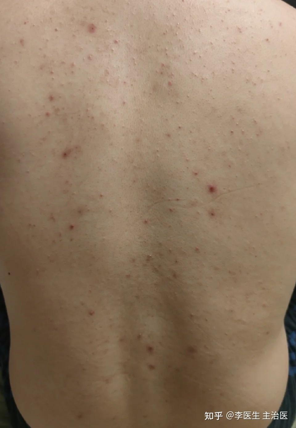 从医学的角度来说了,前胸后背痘痘严重,并且还伴随着出油该怎么解决? - 知乎