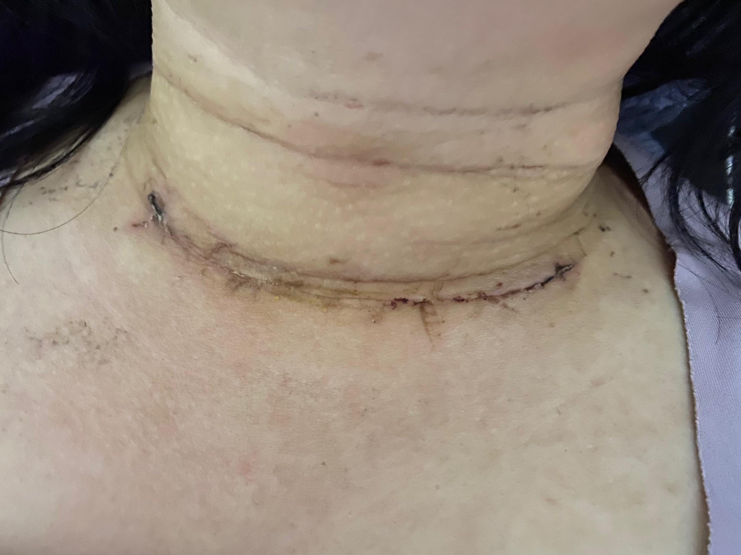 甲状腺结节手术后疤痕图片