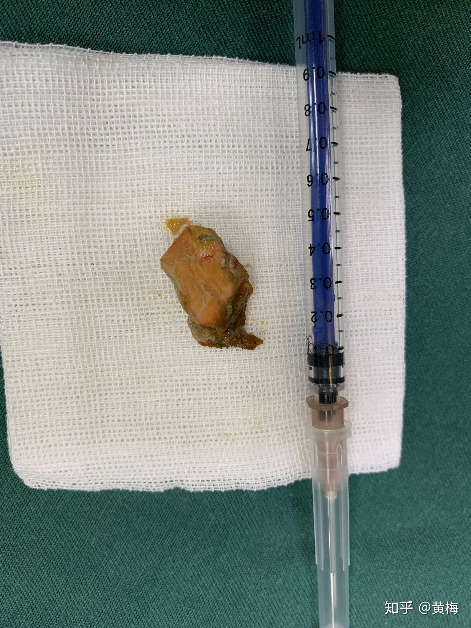 猫咪呕吐 绝食 肠梗阻～记录一下我家猫生病 - 知乎