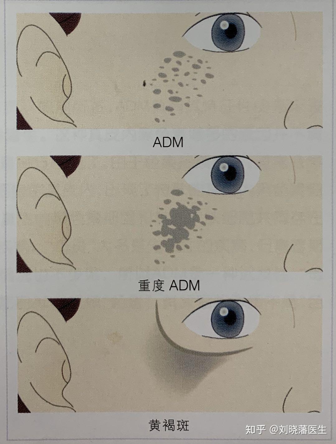 颧骨为什么会长斑?长斑怎么办?