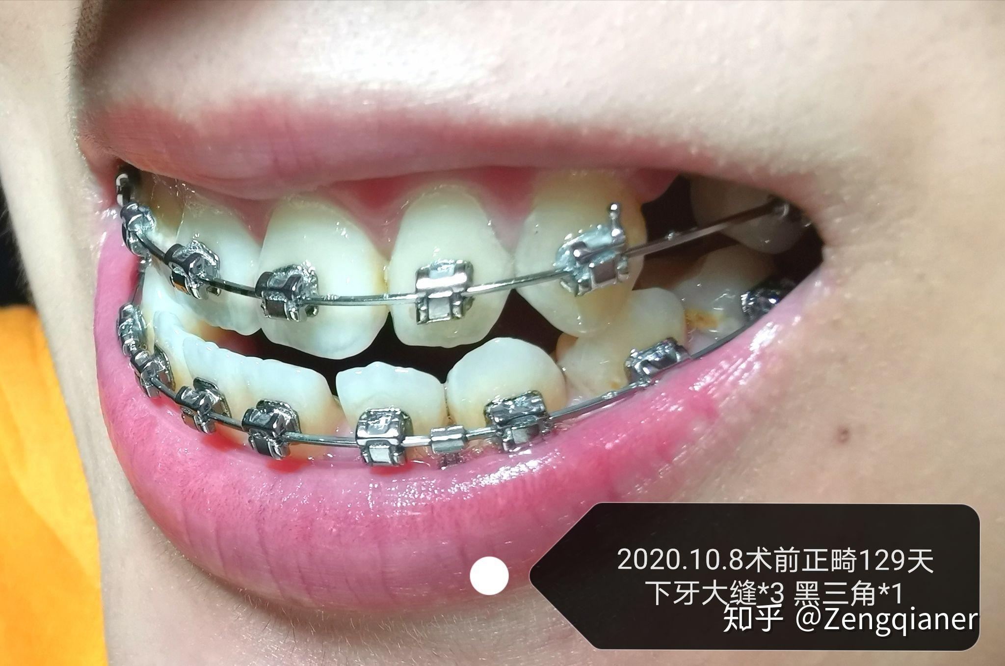 反颌是一种怎样的体验? - 知乎