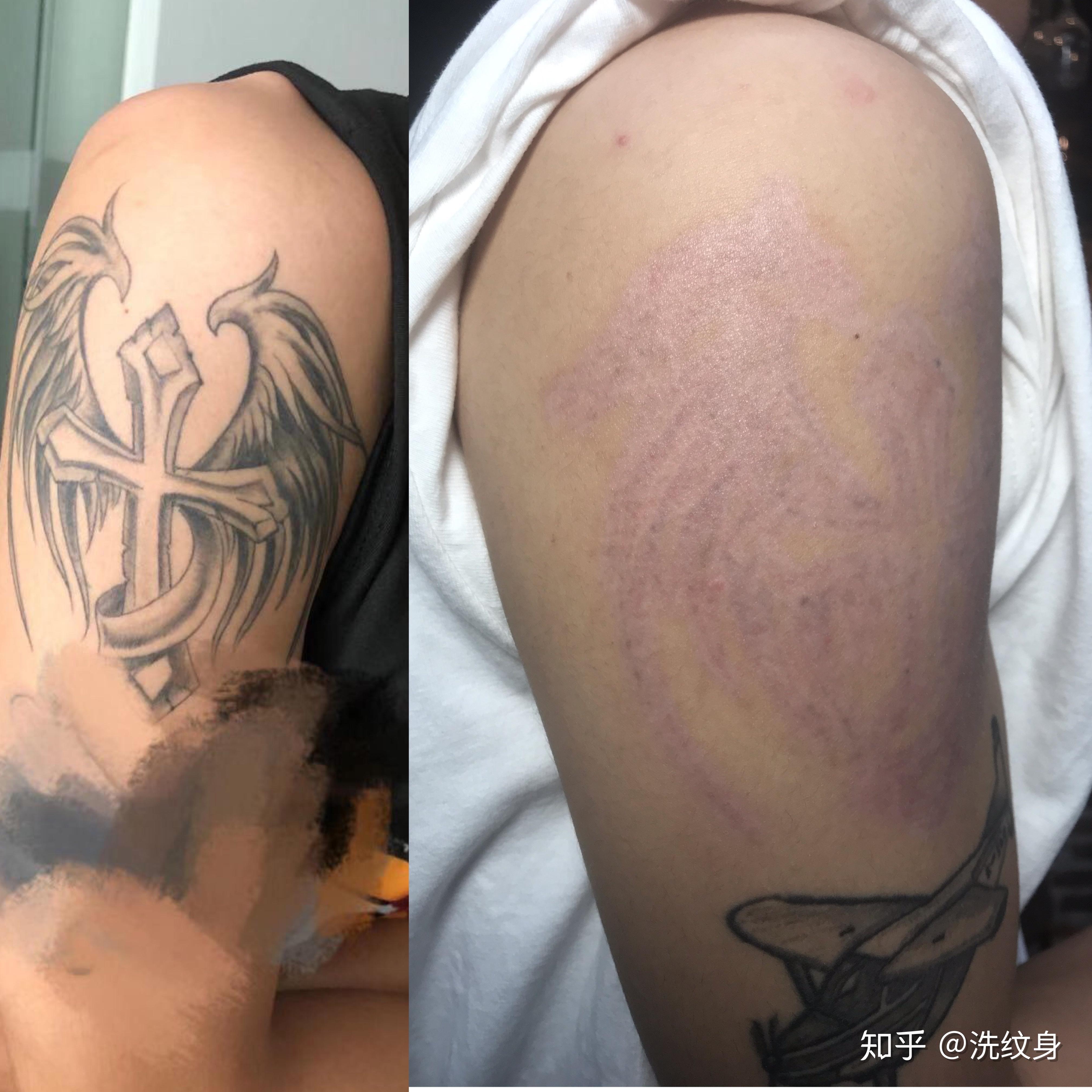 深圳洗纹身正规医院图片