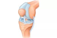 半月板损伤,如何治?如何避免加重?