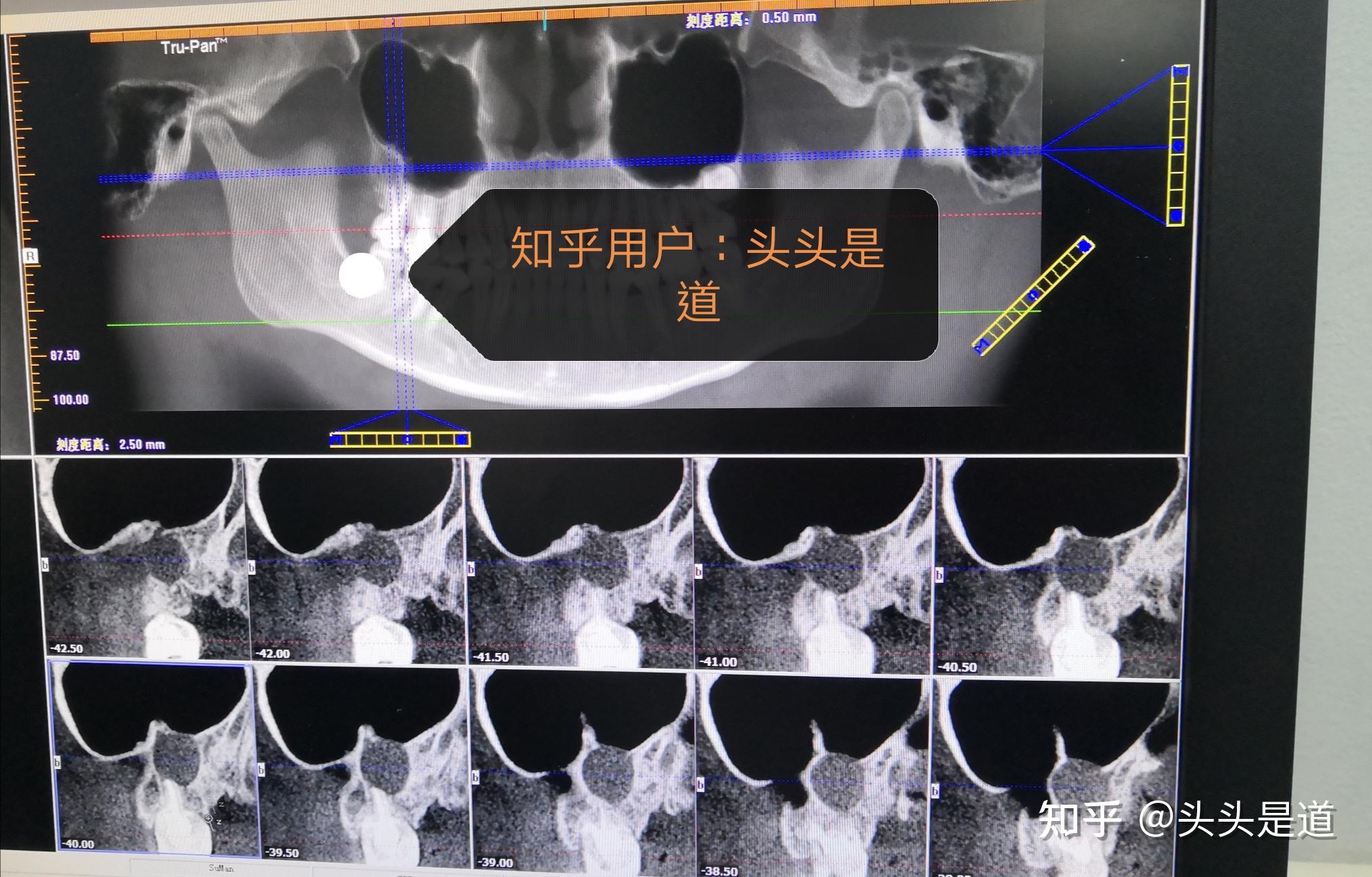 牙源性角化囊肿治疗之路