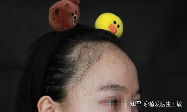 植完发感觉跟没植发一样(植完发后面的头发不长了?)