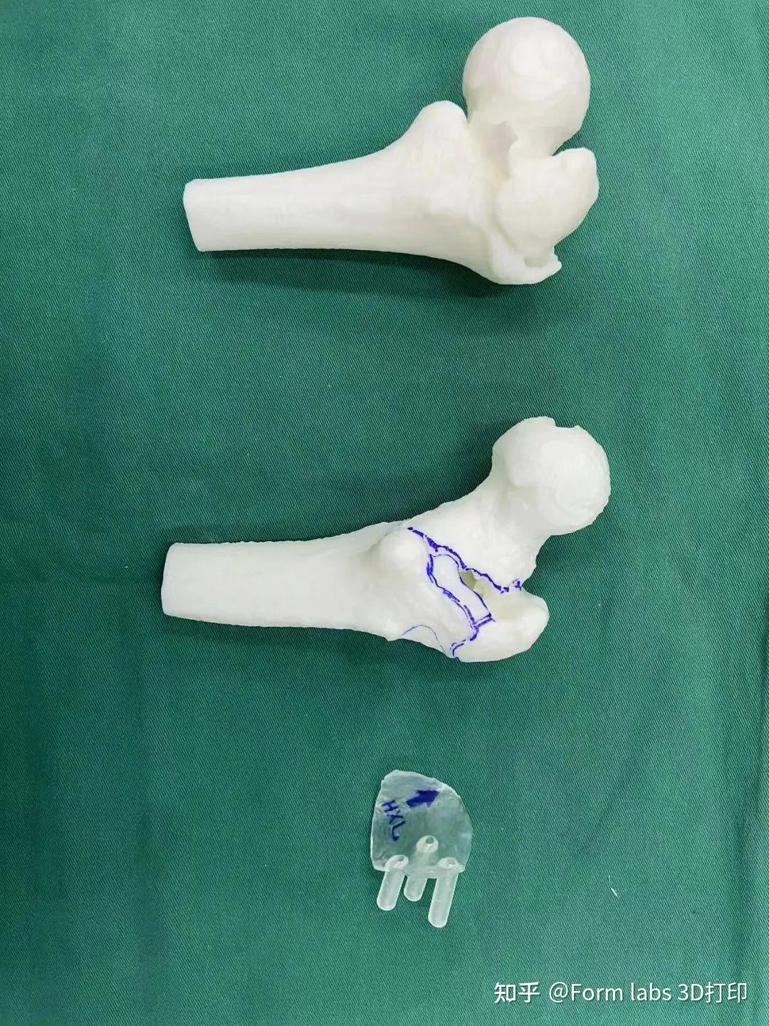 3D打印手术导板在三甲医院应用实例:高效、精确匹配不同手术类型 - 知乎