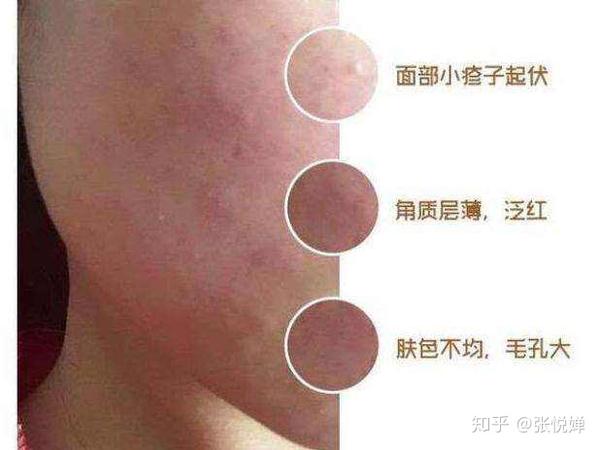 简单实用的祛疹方法，记住这些小细节，让你逆光也美丽 - 知乎