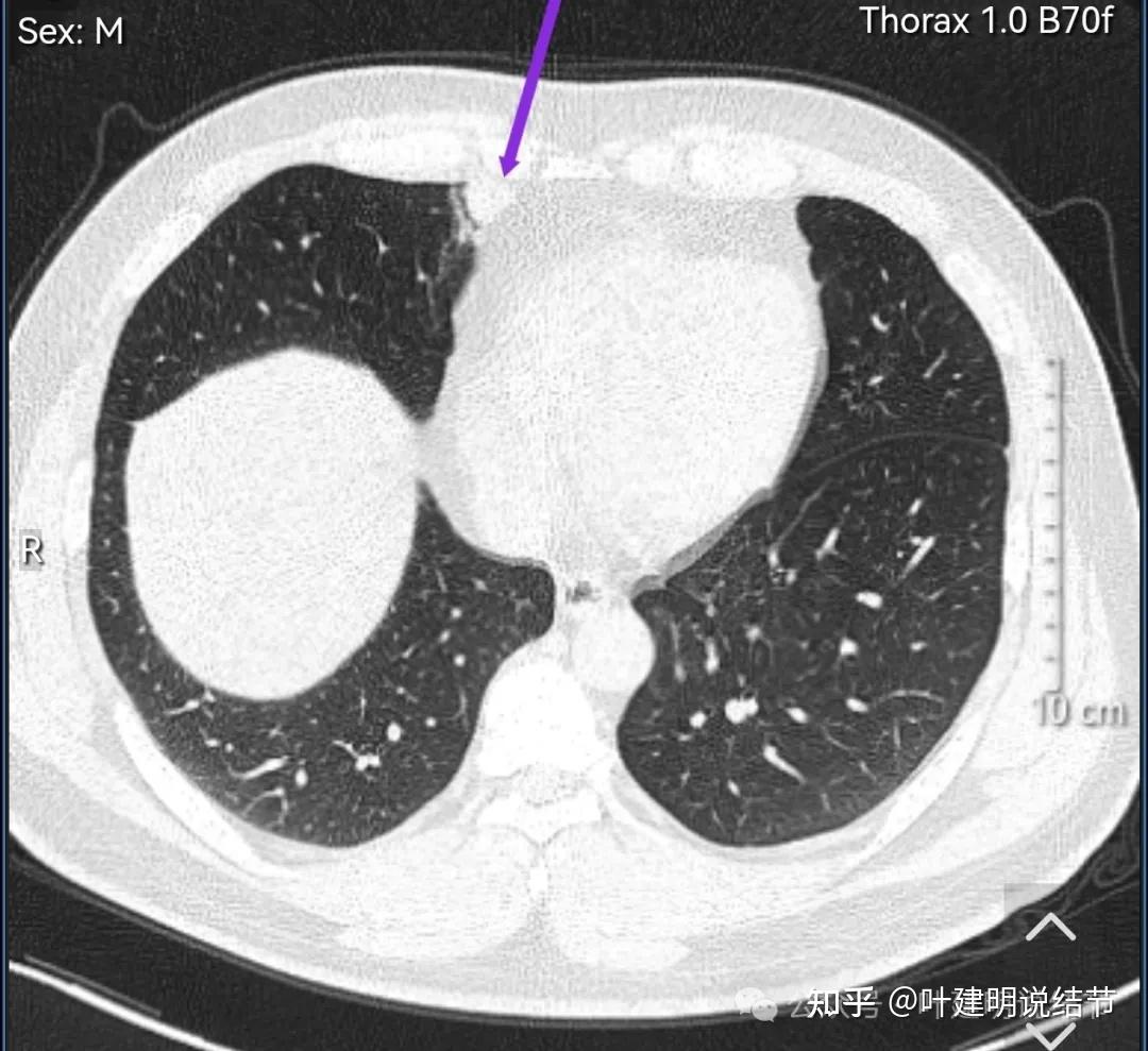 右侧心膈角区在哪里图片